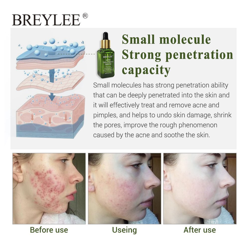 Anti-acne facial serum before and after