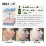 Anti-acne facial serum before and after
