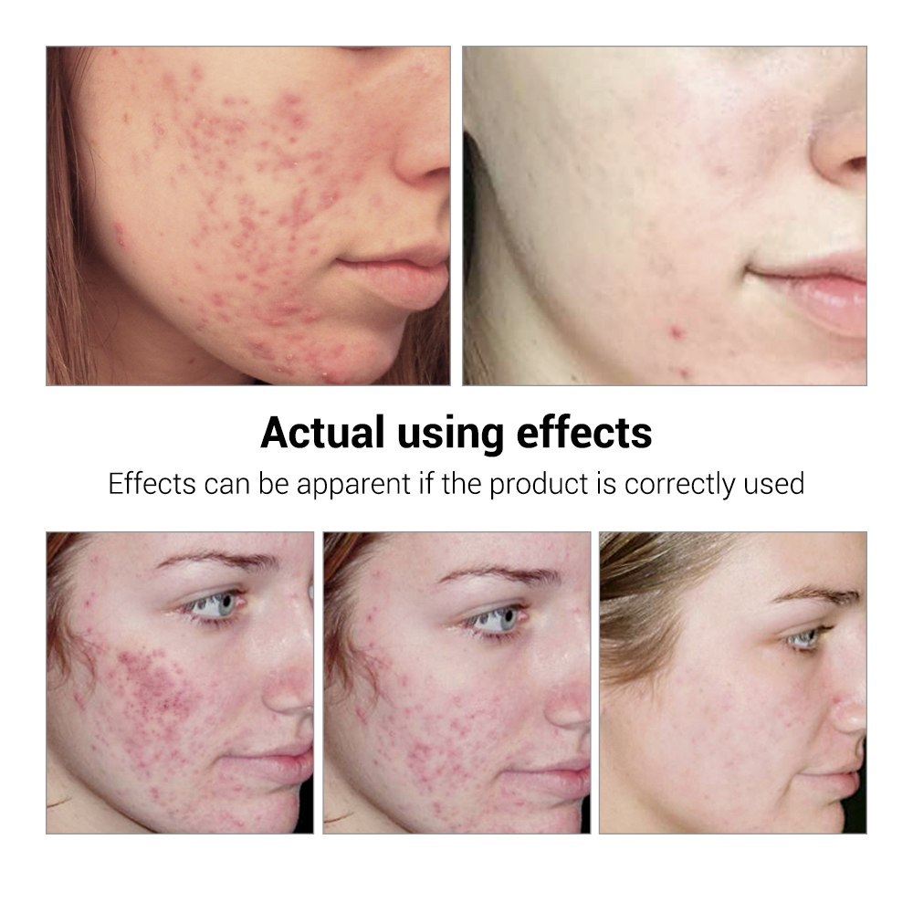BREYLEE skincare for pimples and scars